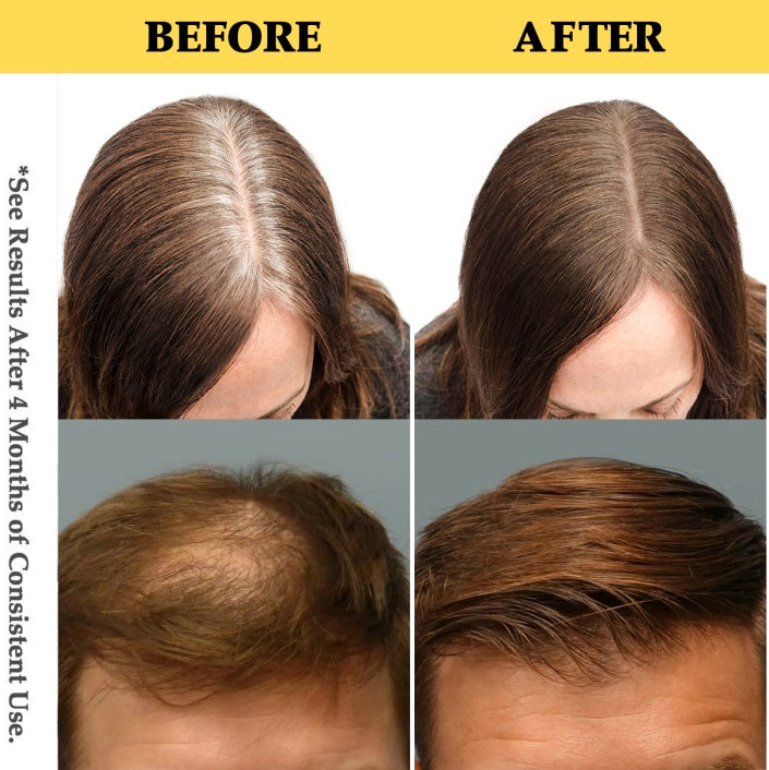Natural Hair Growth Oil - Battana Rosemary Serum Biotin Caffeine Scalp Treatment - Thinning Hair Regrowth And Thickening For Women And Men-It Is Forbidden To Sell On The TikTok Platform